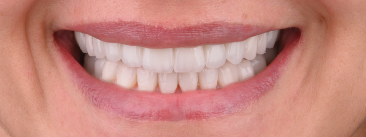 Hollywood smile makeover